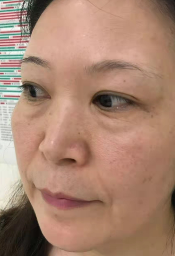 去眼袋手术
