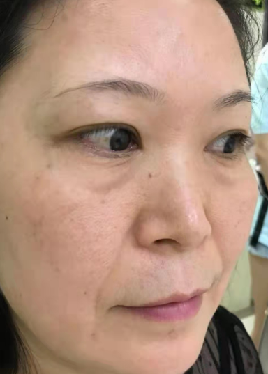 去眼袋手术