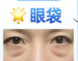 去眼袋手术