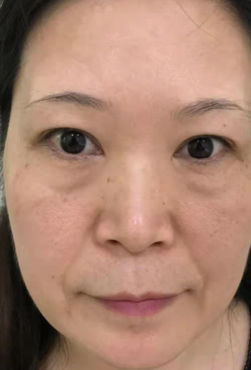 去眼袋手术