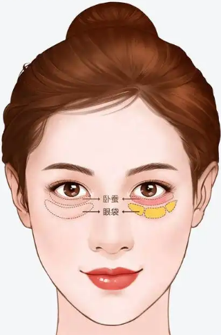 去眼袋手术