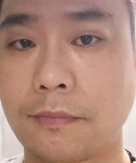 去眼袋手术