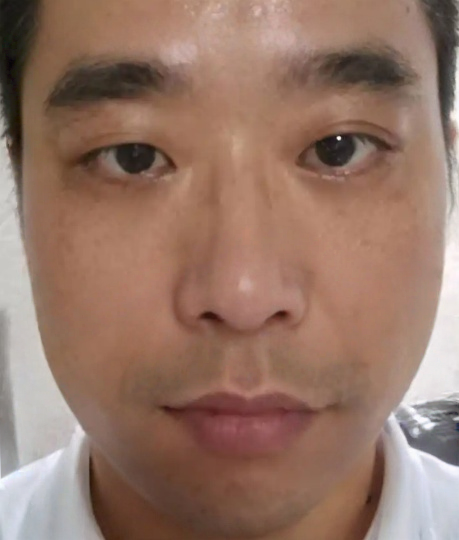 去眼袋手术