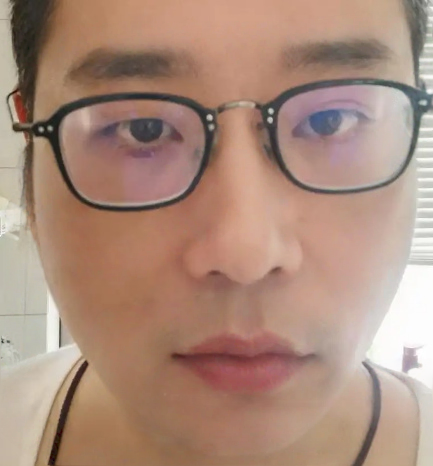 去眼袋手术