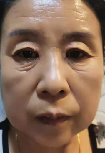 去眼袋手术