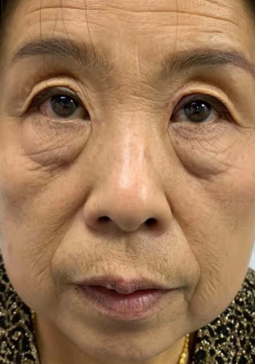 去眼袋手术