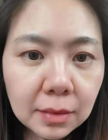 去眼袋手术