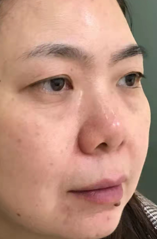 去眼袋手术