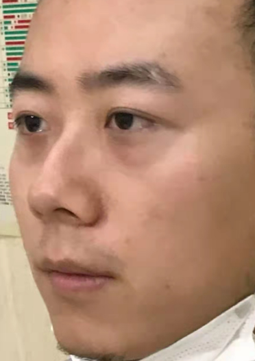 去眼袋手术