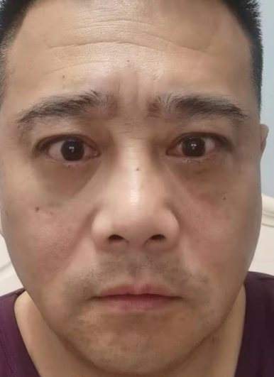 去眼袋手术