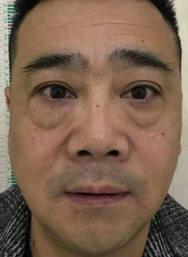 去眼袋手术