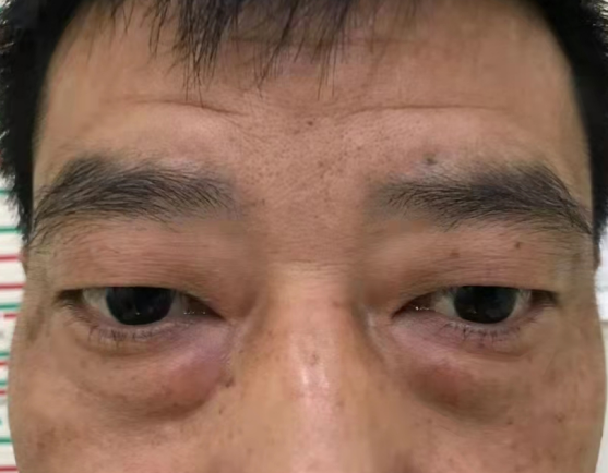去眼袋手术
