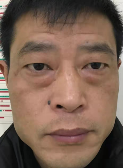 去眼袋手术