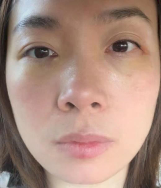 去眼袋手术