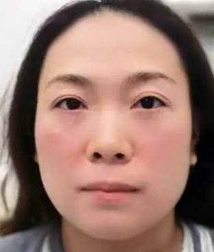 去眼袋手术