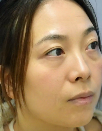 去眼袋手术