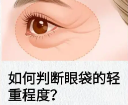 眼袋