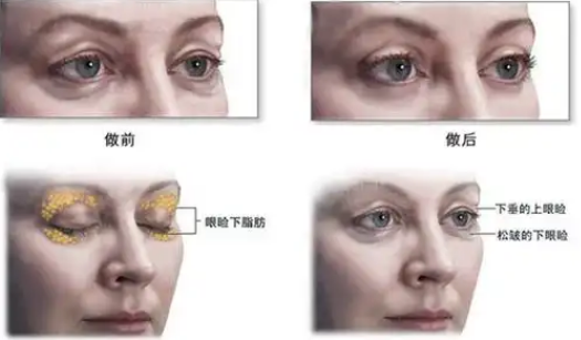 去眼袋手术