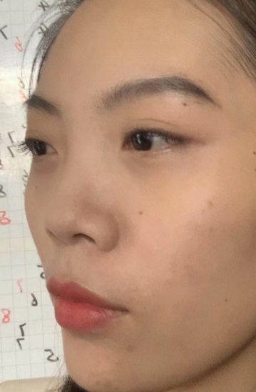 去眼袋手术