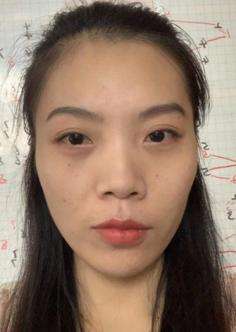 去眼袋手术