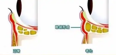 去眼袋手术