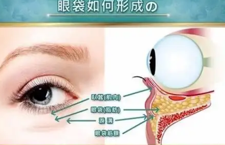 去眼袋手术