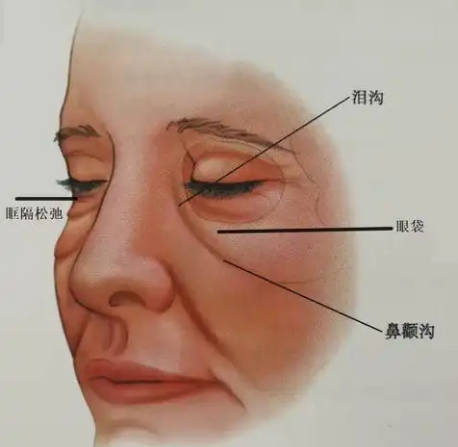 去眼袋手术