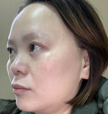 去眼袋手术