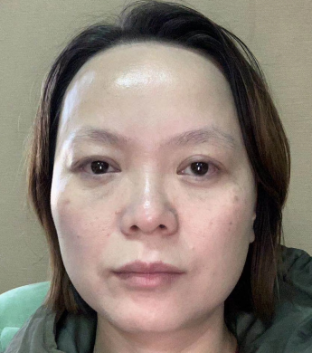 去眼袋手术
