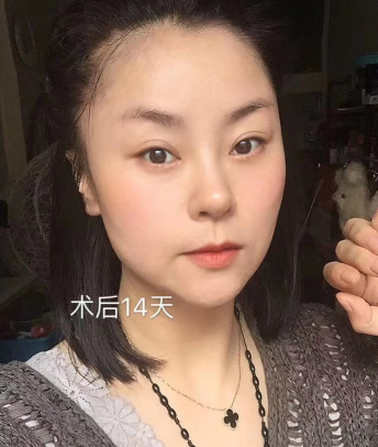 去眼袋手术