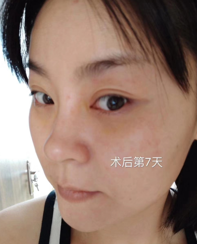 去眼袋手术