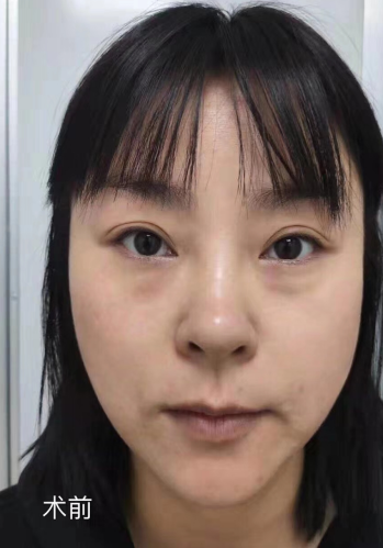 去眼袋手术