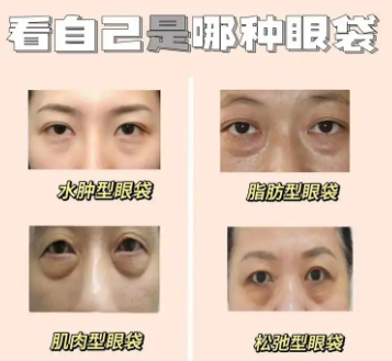 去眼袋手术