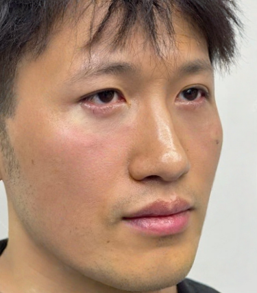 去眼袋手术