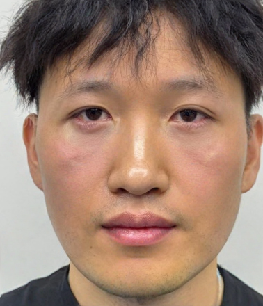 去眼袋手术