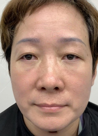 去眼袋手术