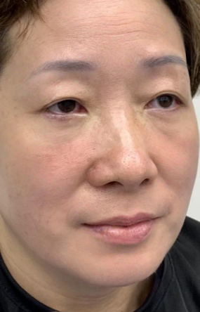 去眼袋手术