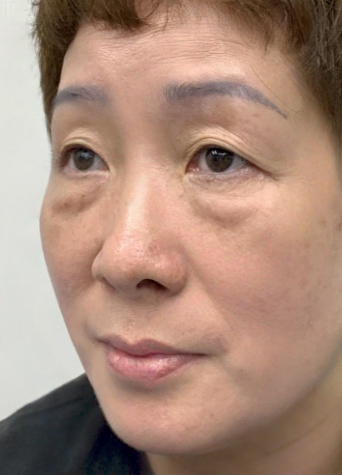 去眼袋手术