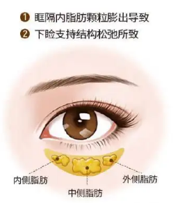去眼袋手术