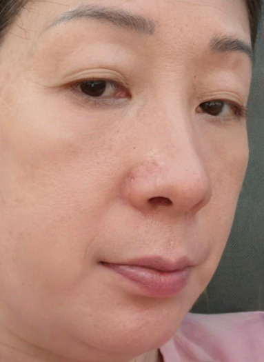 去眼袋手术