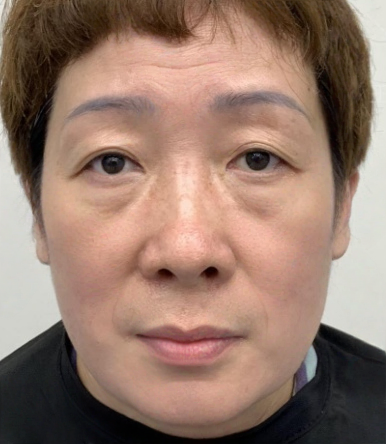 去眼袋手术