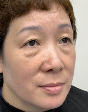 去眼袋手术