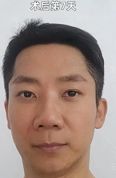 去眼袋手术
