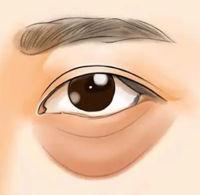 眼袋