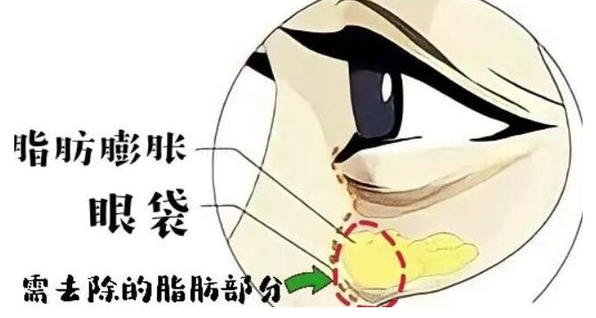 眼袋