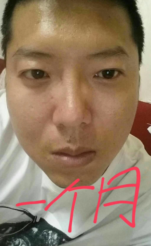 去眼袋手术