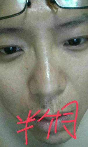 去眼袋手术