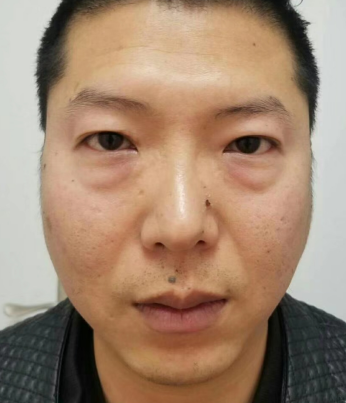 去眼袋手术