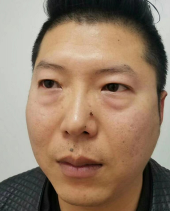 去眼袋手术