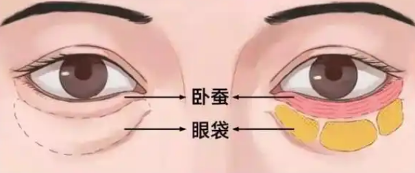 去眼袋手术
